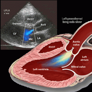 Aortic