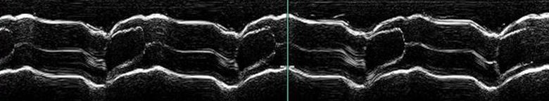 aortic_lines_of_closure